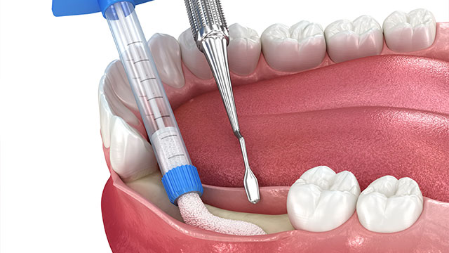 Warren C. Baine, D.M.D. | Extractions, Bone Grafting and Guided Tissue Regeneration and Antibiotic Treatment